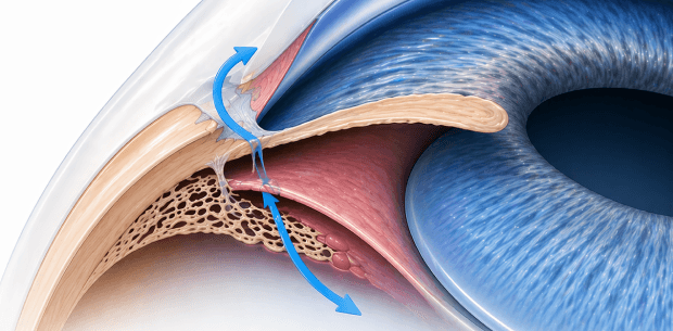 cataract eye image